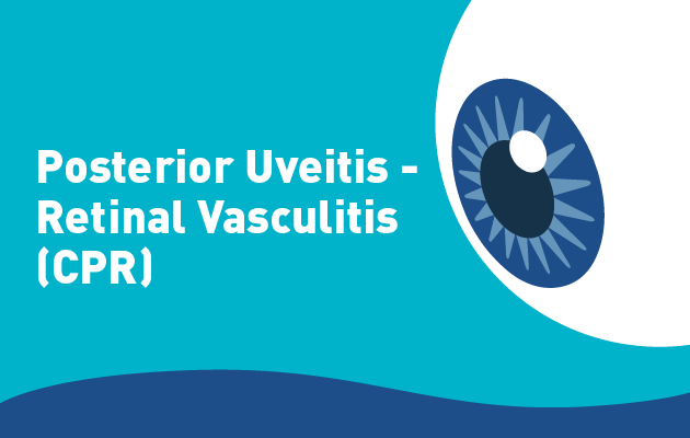 Posterior Uveitis - Retinal vasculitis (CPR)